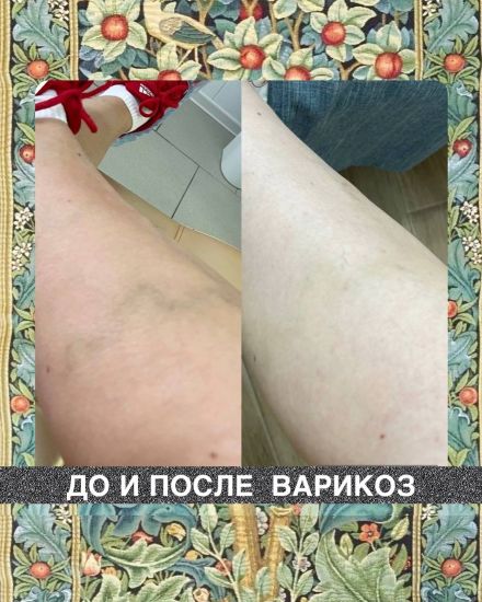 [Наталия Травникова] Варикоз (2025)